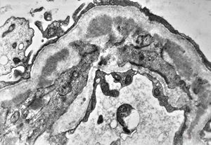 F,28y. | type I membranoproliferative glomerulonephritis F,28y. | type I membranoproliferative glomerulonephritis